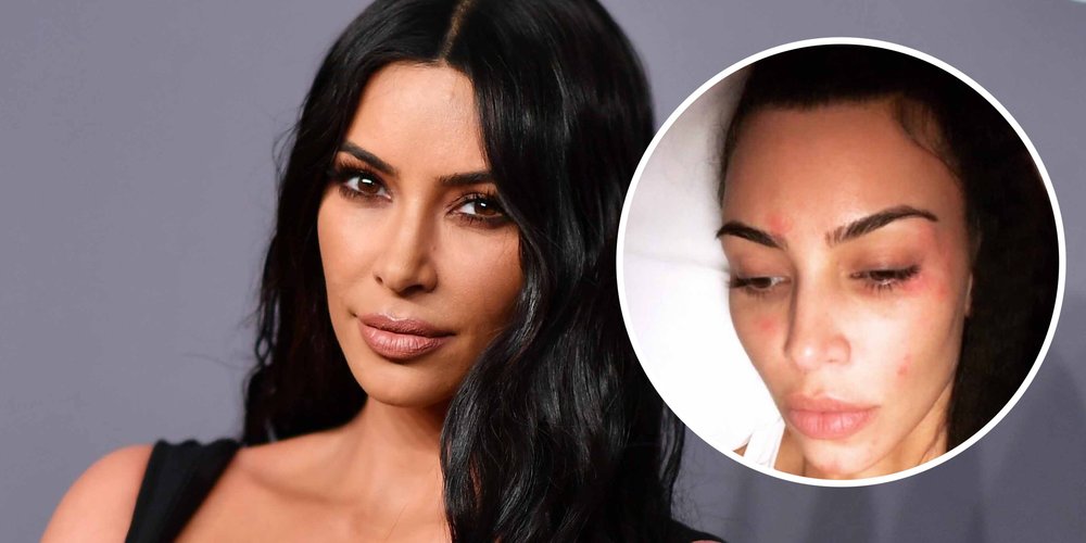 Kim Kardashian is Treating Her Psoriasis Using These Amazing 